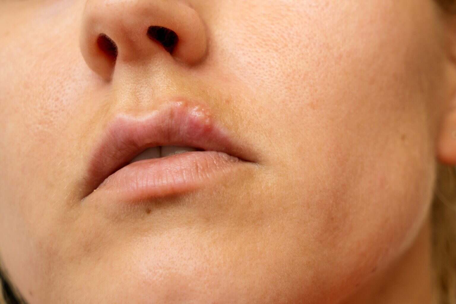 Les solutions naturelles pour soigner les boutons de fièvre Cold sore on the lip