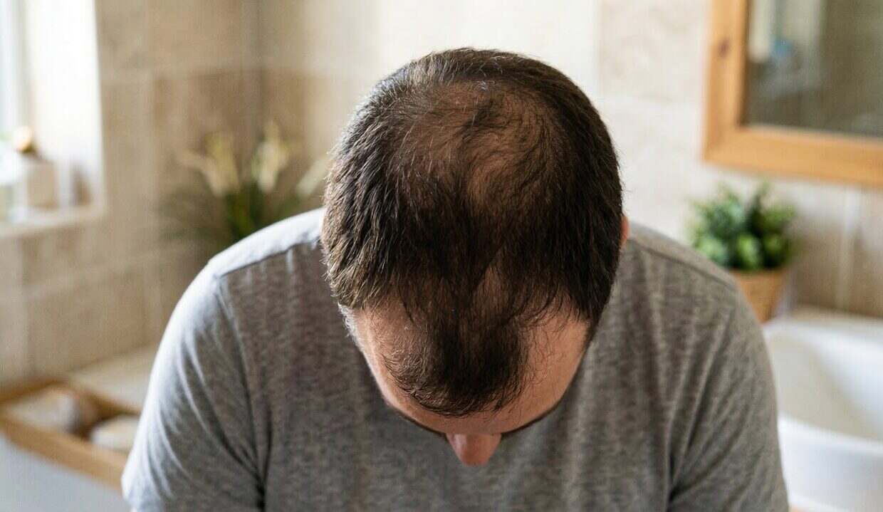 Stopper la perte de cheveux : ce que personne ne vous dit vraiment perte de cheveux